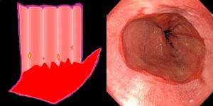 Esofagitis grado B