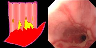 Esofagitis grado C