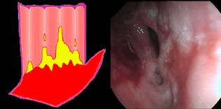 Esofagitis grado D