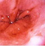 Esofagitis grado 1