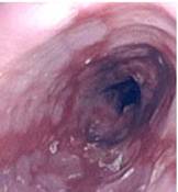 Esofagitis grado 2