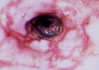 Esofagitis grado 3