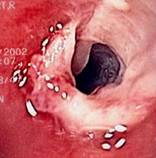 Esofagitis grado 4