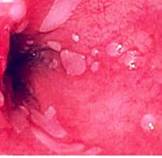 Esofagitis grado 5