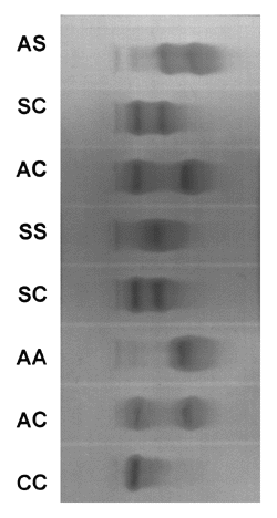 Elctroforesis hemoglobina