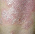 psoriasis