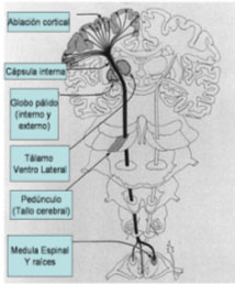 Figura 1. Esquema que representa el encfalo y tallo cerebral. Se muestran diferentes tipos de lesiones que se relacionaron con diferentes perodos histricos en la ciruga de los trastornos del movimiento.