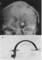 Figura 3. A, Rx de crneo (ntero-posterior) donde se observa imagen contrastada (flechas) perteneciente a un balon intracerebral en la proyeccin de los GB. B, Sistema estereotctico de Cooper .