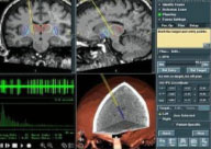 Figura 5. Software donde se planifica la colocacin de un electrodo de estimulacin cerebral profunda en el NST
