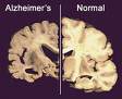 Enfermedad del Alzheimer.