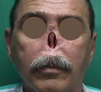 Paciente tributario de prótesis nasal