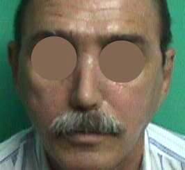Paciente rehabilitado con prótesis nasal adhesiva