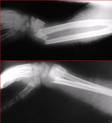fractura mu�eca