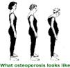 Osteoporosis