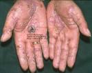 Psoriasis palmar