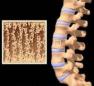 Fractura vertebral