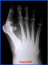 Hallux Valgus