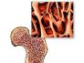 Osteoporosis