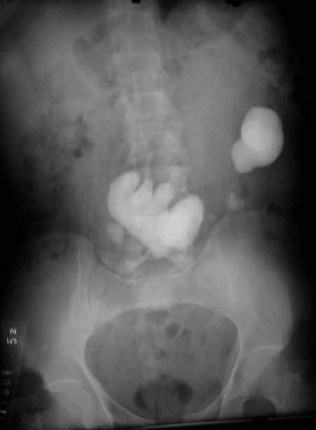 Los dolores en los riñones después de la operación de la hernia intervertebral