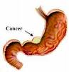 Cáncer gástrico