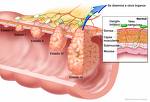 Cáncer de recto