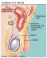 Tcnica de Herniorrafia inguinal