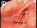 Estenosis por lcera duodenal